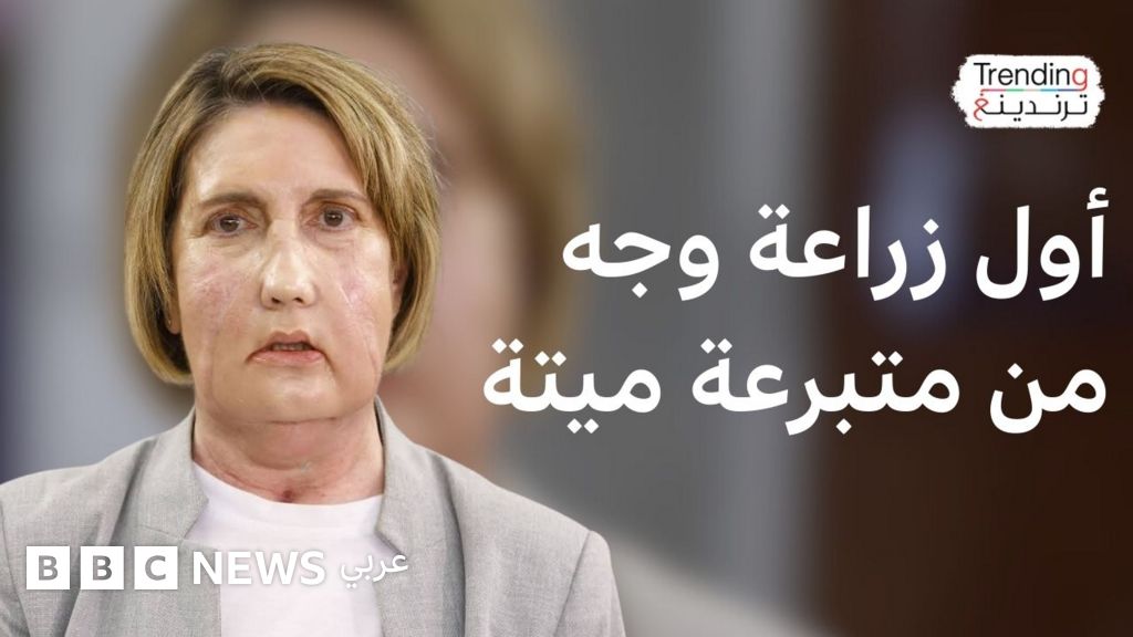 أول زراعة وجه من متبرعة ميتة: “أصبحت أشبه نفسي”